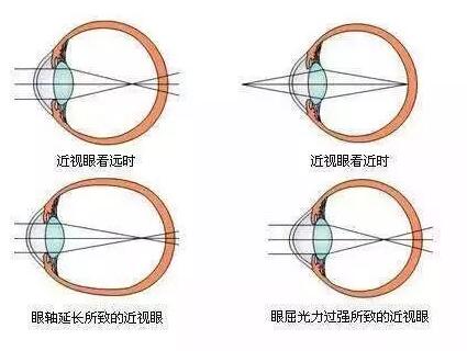 “小孩视力以前挺好的，没想到一个寒假下来就近视了。”昨天的6686在线登录官网入口-6686(中国)小儿眼科门诊里，很多家长都反应说，“孩子期末成绩不错，所以假期里对他的管束放松了，一有空就拿起手机玩。直到前几天，他嚷着看东西变模糊了，才带孩子来医院检查，检查结果是左右眼出现不同程度的近视，医生建议配戴眼镜。.jpg