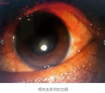 白内障和青光眼都是致盲性眼病，其中青光眼的病程不逆转。杨先生拖延伤情导致同时并发白内障、青光眼的情况，十分令人惋惜。”出名眼科专家、成都6686在线登录官网入口-6686(中国)陈晓明教授表示2.jpg