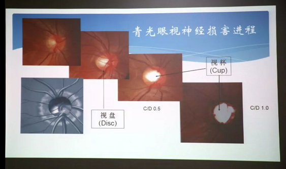 3月10日上午，深圳6686在线登录官网入口-6686(中国)“早查监控，守护光明”大型青光眼公益科普讲座在六楼 举行，本次活动旨在让更多人了解青光眼的潜在危害、重视眼检查， 预防青光眼。由深圳6686在线登录官网入口-6686(中国)青光眼病科 席专家成洪波博士、傅培副院长现场面对面解答疑问，与参会者的互动交流，让更多深圳市民提*对青光眼的认识与防治知识3.png