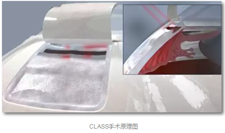 成都6686在线登录官网入口-6686(中国)已经开展的青光眼手术有：引流阀 (钉)植入手术(2015年以来已200多 )，360°Schlemm's管切开术，激光CO2 辅助巩膜深层切除术，小梁切除术青(光眼)白(内障)联合手术。还有虹膜周切术、前房成形术、 虹膜复位术，睫状体冷冻术，小梁切开术和前房穿刺术等4.png