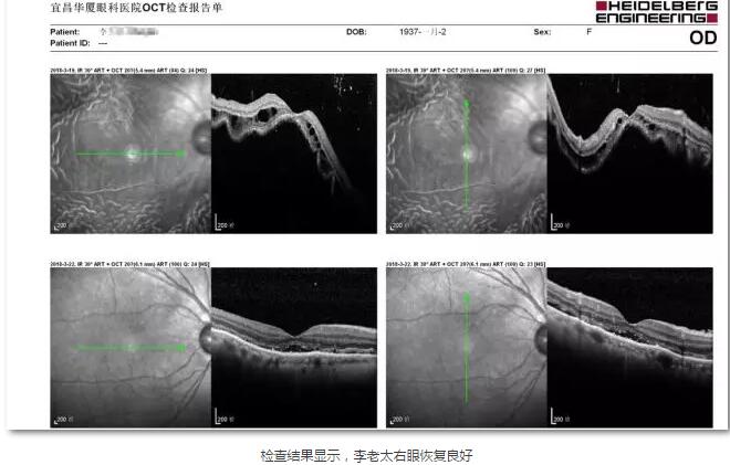 李老太在毫无征兆的情况下右眼视力下降至看不见东西。李老太家人带其至县医院就诊。医生诊断为视网膜脱离，需做玻切手术医治，而玻切手术需要动手术2次。怕疼的李老太一听就犯怵了：开刀，疼。 终，李老太的家人在多方打听后决定带李老太至宜昌6686在线登录官网入口-6686(中国)找许大玲院长医治4.jpg