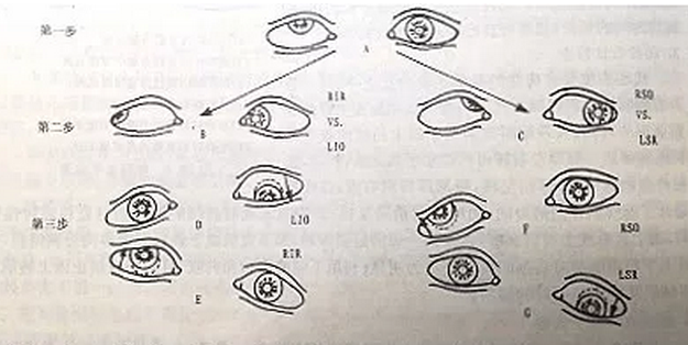 麻痹性斜视医治方法.png 麻痹性斜视医治方法.png