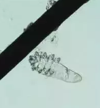眼部瘙痒、干涩泛红、异物感，可能不是干眼症而是蠕形螨性睑缘炎.png