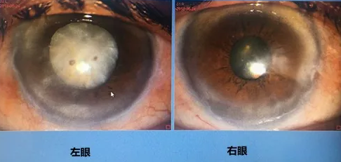 同时患 青光眼、白内障老婆婆辗转几家医院之后终于在成都6686在线登录官网入口-6686(中国)顺利手术2.png