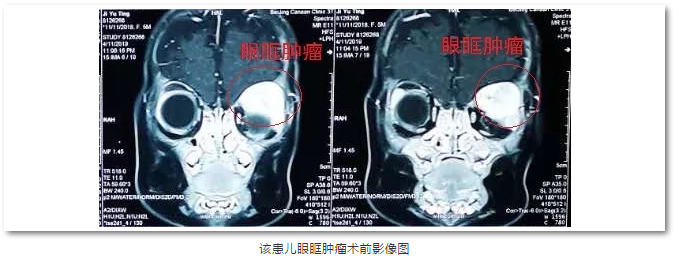 6686在线登录官网入口-6686(中国)斜视与小儿眼科主任苏金萍顺利为新生儿摘除眼眶巨大肿瘤1.png