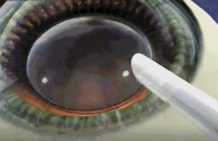 3月13日上海和平眼科医院ICL晶体手术半价日,近视朋友千万不可错过1.gif 3月13日上海和平眼科医院ICL晶体手术半价日,近视朋友千万不可错过1.gif